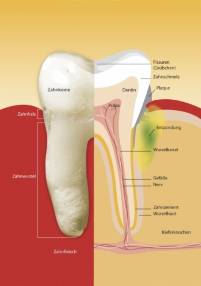 Parodontitis: Häufige Ursache für Zahnverlust